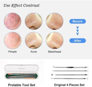 مجموعة إبر حب الشباب (4 قطع)، علاج الرؤوس السوداء والبثور-B0G1MYRPHX
